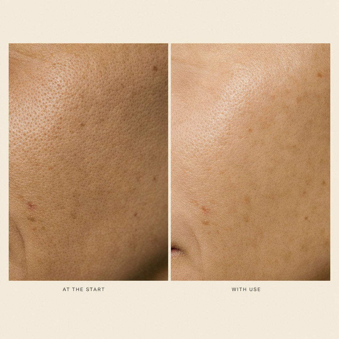 Close-up of cheek skin showing pore texture at the start and with use